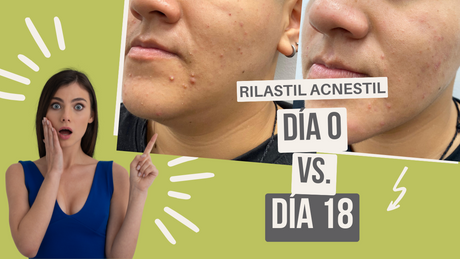 Rilastil Acnestil: Guía completa para pieles con tendencia acneica